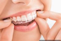 What Every Adult Needs to Know About Invisalign