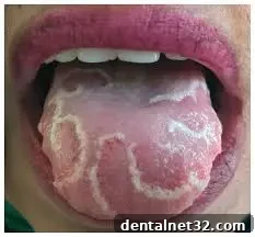 Decoding Geographic Tongue Symptoms and Solutions 2 A close-up image showing the distinct, map-like red patches with white borders characteristic of Geographic Tongue.
