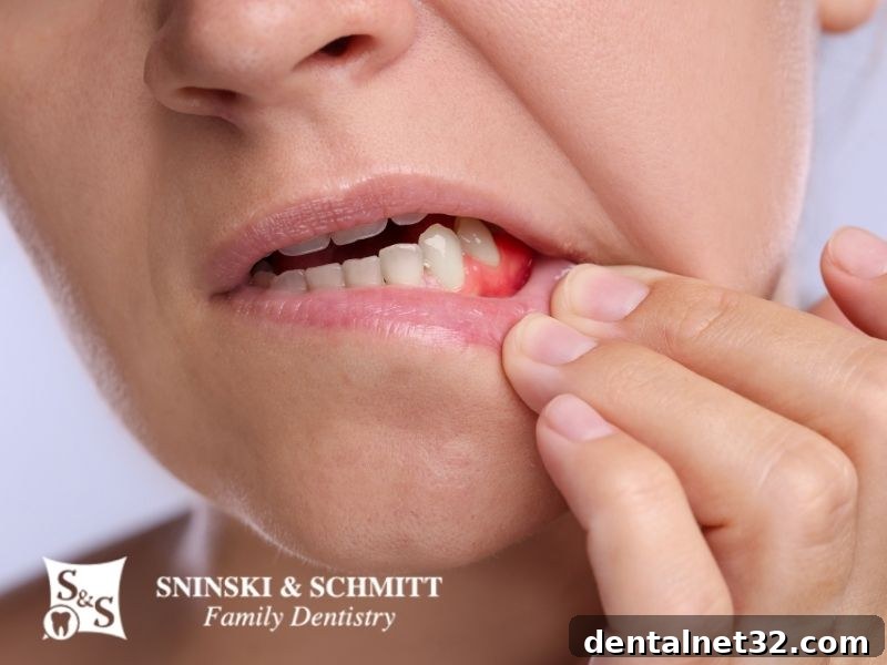 Diagram showing inflamed gum tissue