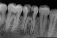 Structural Tooth Damage vs Surface Wear: How to Tell the Difference